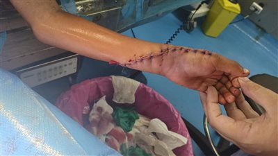 إنقاذ طفل بعد إصابته بقطع بالأوتار وكسور باليد بمستشفى دمياط العام