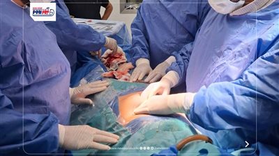 مستشفى ملوى التخصصي تنقذ حياة سيدة بعد إصابتها بطلق ناري خطير في المنيا