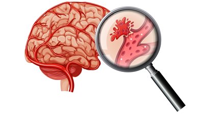 كل ما تريد معرفته عن السكتة الدماغية.. الأعراض والأسباب وطرق الوقاية