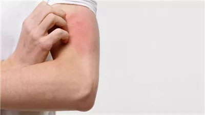 كل ما تريد معرفته عن التهاب الجلد التأتبي.. الأعراض والأسباب وطرق الوقاية