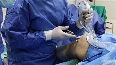  نجاح عملية منظار ركبة بمستشفى السادات المركزي ضمن مبادرة تخفيض أسعار العمليات