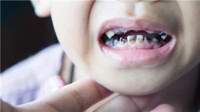 طرق فعّالة للوقاية من تسوس الأسنان أثناء تناول حلويات المولد 