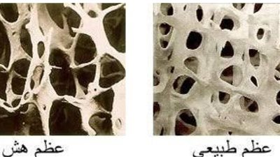 ما هي هشاشة العظام؟ الأسباب والأعراض والعلاج الوقائي