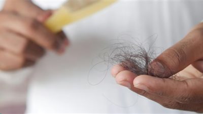 الصودا هي السبب.. المشروبات الغازية قد تؤدي إلى الصلع