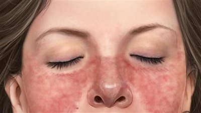  الذئبة عند مهاجمة جهازك المناعي لأنسجة جسمك وأعضائه (مرض في المناعة الذاتية)