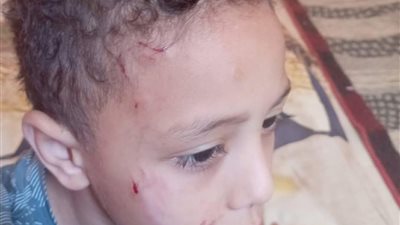 كلب ضال  يعقر طفل في الشيخ زايد بالسويس                                  