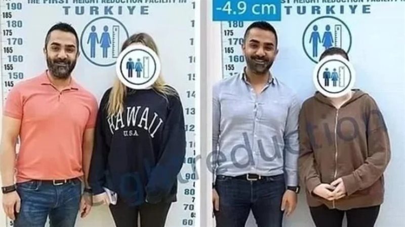 جراحة تقصير الساقين