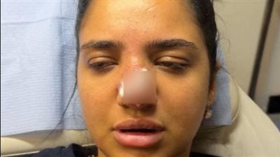 «مناخيري كانت هتروح».. كنزي مدبولي تتعرض لخطأ طبي بسبب حقنة فيلر 