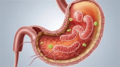 5 أنواع من سرطان المعدة سريعة النمو.. احذر تجاهل هذه الأعراض