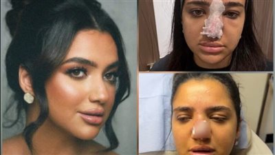 بعد أزمة كنزي مدبولي.. طبيب يكشف لـ نيوز رووم مخاطر فيلر الأنف 