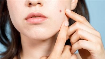 بلاش منها أحسن.. 3 أطعمة تُسبب ظهور حب الشباب احذريها