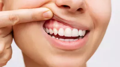 من الفم إلى القلب.. كيف تُسبب البكتيريا الفموية النوبات القلبية؟