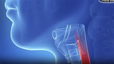 لأول مرة عالميًا.. علاج حالة أكالازيا مستعصية بنسبة 100%
