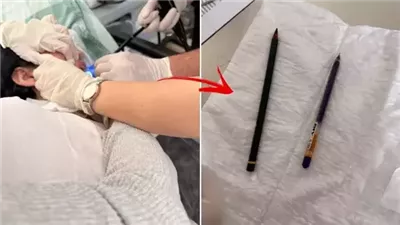 بسبب الوسواس القهري.. استخراج قلمين من معدة فتاة تركية 