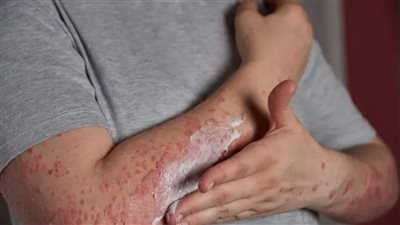 اكتشف أهم أسباب الصدفية وطرق الوقاية الفعالة للحفاظ على صحة بشرتك