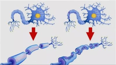 مرض تهتك العصب المزمن..الأعراض والأسباب وطرق العلاج الحديثة 	
