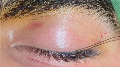 نجاحات طبية مميزة لفرق جراحة الوجه والفكين بمستشفيات المنوفية 