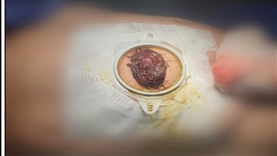 عانت من انسداد معوي كامل.. أطباء «صحة الشرقية» يستعيدون مُسنة من الموت 