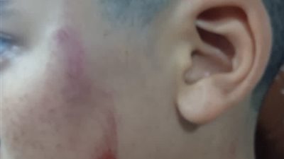 «بهدله وشه» .. أب يتهم مدرس بالتعدي على نجله بالضرب وإصابته ببولاق الكرور