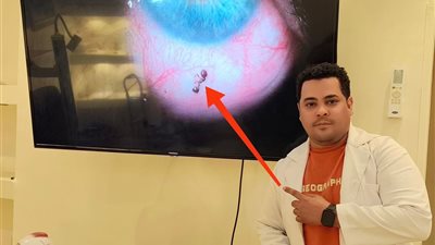 مفاجأة صادمة في الأقصر.. نملة حيّة داخل عين سيدة 3 أيام