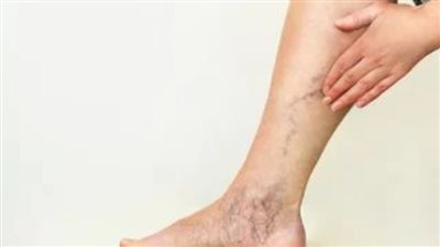 لماذا تصاب بالدوالي؟ الأسباب والأعراض وخيارات العلاج