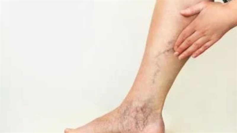 كيفية علاج الدوالي