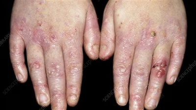 انحلال البشرة الفقاعي المفصلي: مرض جلدي نادر وأسبابه 	