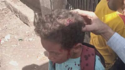 مضروب بـ«طوبة».. تداول صور لتلميذ مصاب بالرأس أمام مدرسة ابتدائي في قنا
