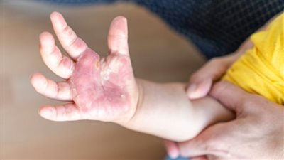 كيفية التعامل مع الحروق عند الأطفال: نصائح وإرشادات هامة للعناية والوقاية 