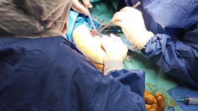 صحة الشرقية: جراحة عاجلة تنقذ ذراع مريض من البتر بمستشفى أبو كبير المركزي