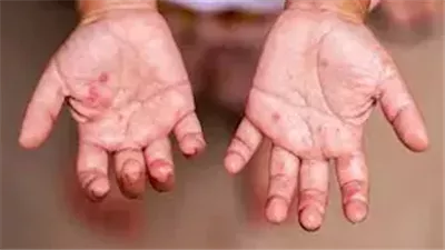 بعد غلق فصل في مدرسة بسبب هذا المرض.. أمجد الحداد يكشف خطوات الوقاية من HFMD