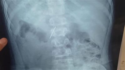 «طفل المسمار».. نجاح طبي كبير داخل مستشفي الأطفال التخصصي في بنها