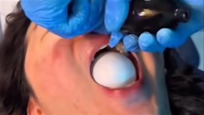 بالون الجيوب الأنفية ترند خطير يجتاح مواقع التواصل الاجتماعي 