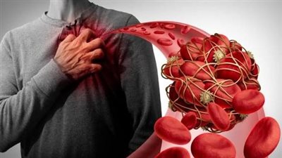 ليست الوراثة فقط.. 4 أسباب رئيسية وراء الجلطات وفق دراسة جديدة 	