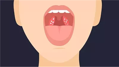 لماذا تسبب حصوات اللوزتين رائحة الفم الكريهة؟ تعرفي على الأسباب والعلاج