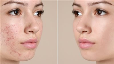 من التونر إلى المرطب.. منتجات شائعة تسبب البثور دون أن تدري 	