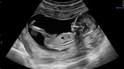 دراسة.. تلوث الهواء يبطئ نمو دماغ الأطفال حديثي الولادة