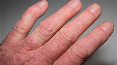 التهاب المفاصل الصدفي.. تعرف على علاماته وأسبابه وكيفية إدارته