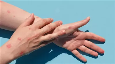 بقع حمراء متقشرة على بشرتك؟ طبيبة تشرح الأسباب والعلاج