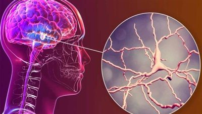 علماء يطورون نظام ذكاء اصطناعي يشخص نوعا من ورم الدماغ