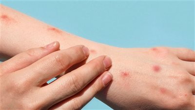 فرق الطب الوقائي تعقم الفصول وتتابع 500 تلميذ لمواجهة جدري الماء