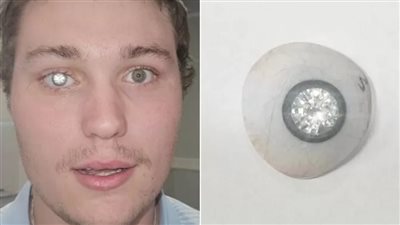 أغلى عين إصطناعية.. صائغ أمريكي يحوّل مأساته إلى تحفة فنية