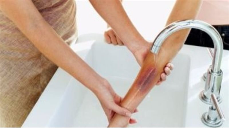 لعلاج الحروق
