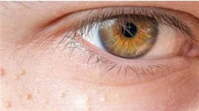 رعشة العين.. عرض بسيط أم إنذار بمرض عصبي خطير؟ .. تفاصيل