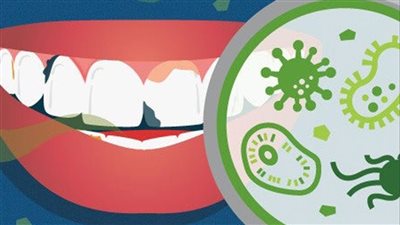 العلاقة الخفية بين صحة الفم وخطر الإصابة بالسكتة الدماغية