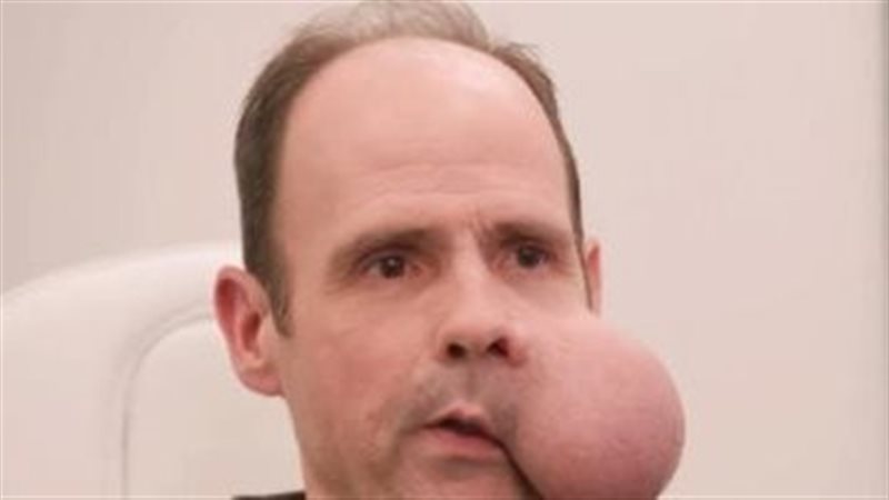 رجل يعيش بورم