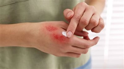 لماذا لا تلتئم الجروح بسرعة؟ أسباب خفية قد لا تعرفينها 