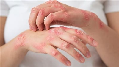 النظام الغذائي لمرضى الصدفية: الأطعمة التي يجب تناولها