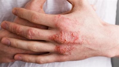 علاج ثوري جديد للتخلص من آلام الإكزيما المؤلمة والمنهكة  