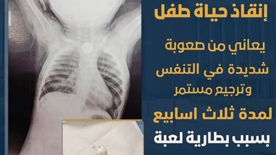 في اللحظة الأخيرة.. فريق طبي بالأقصر يستخرج بطارية من مريء طفل عمره 10 أشهر